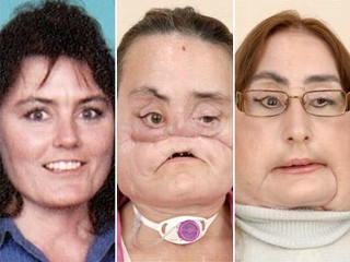 ht_face_transplant_090505_mn.jpg